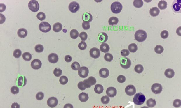 Analysis of a case of Babesia canis
