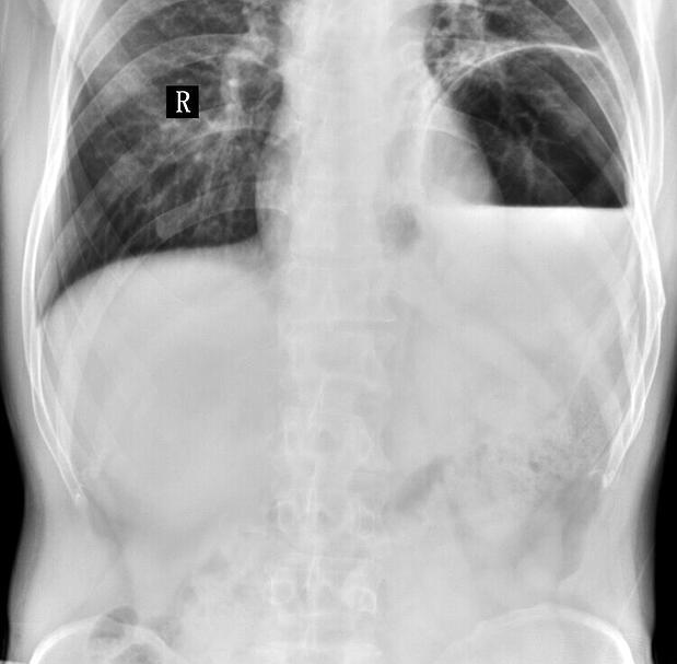 Diagnosis and treatment of diaphragmatic hernia in dogs